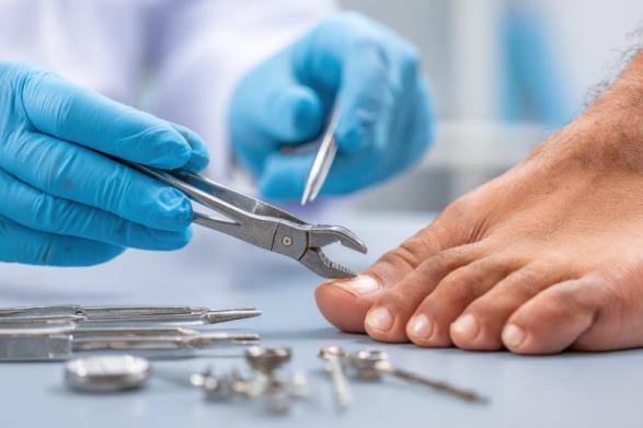 Retrait de cors Marseille 7