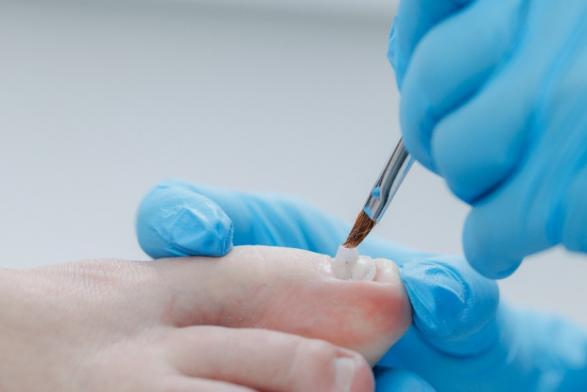  reconstruction ongle podologue